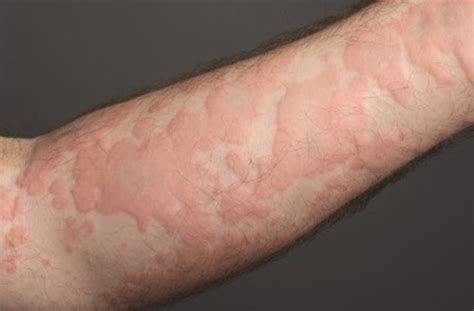 scratch test urticaria|how to describe urticaria.